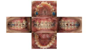 叢生・ラビアル