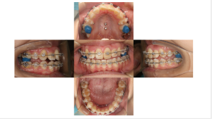 叢生・ラビアル