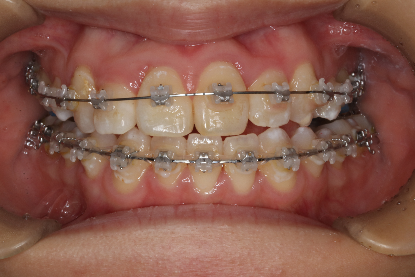 叢生・ラビアル