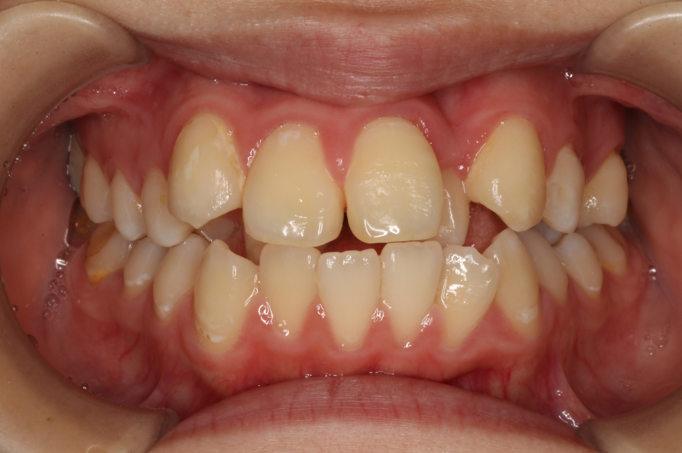 叢生・ラビアル