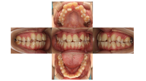 叢生・ラビアル