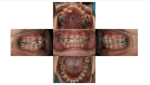 叢生・ラビアル