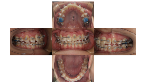 叢生・ラビアル