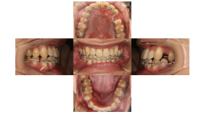 下顎前突・ハーフリンガル矯正の症例