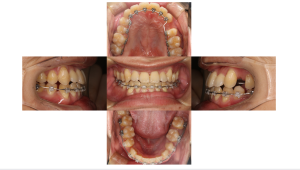 下顎前突・ハーフリンガル