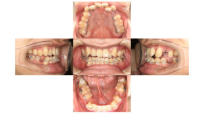 下顎前突・ハーフリンガル