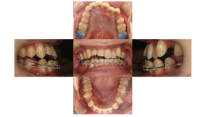下顎前突・ハーフリンガル矯正の症例