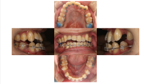 下顎前突・ハーフリンガル