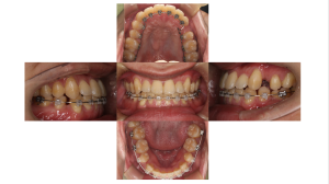 ハーフリンガル・下顎前突