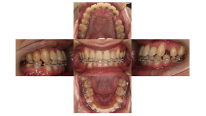 下顎前突・ハーフリンガル矯正の症例