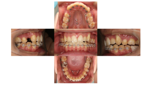 八重歯、叢生・ハーフリンガル矯正の症例