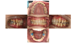 叢生・リンガル矯正の症例