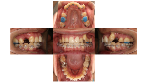 八重歯、叢生・ハーフリンガル矯正の症例