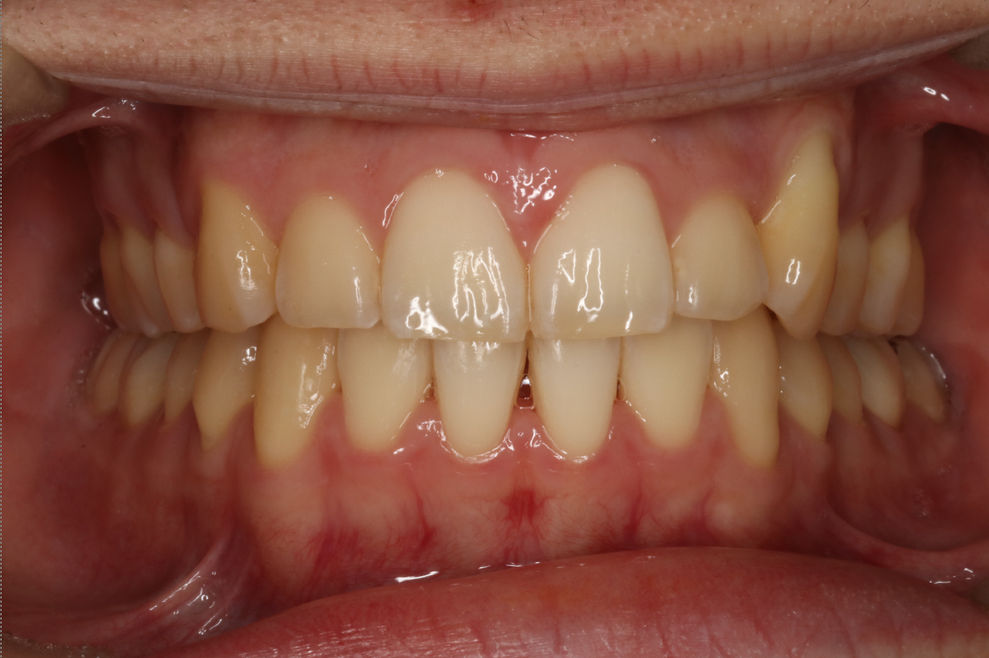 八重歯、叢生・ハーフリンガル矯正の症例