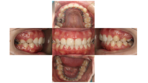 上顎前突・叢生・リンガルの症例