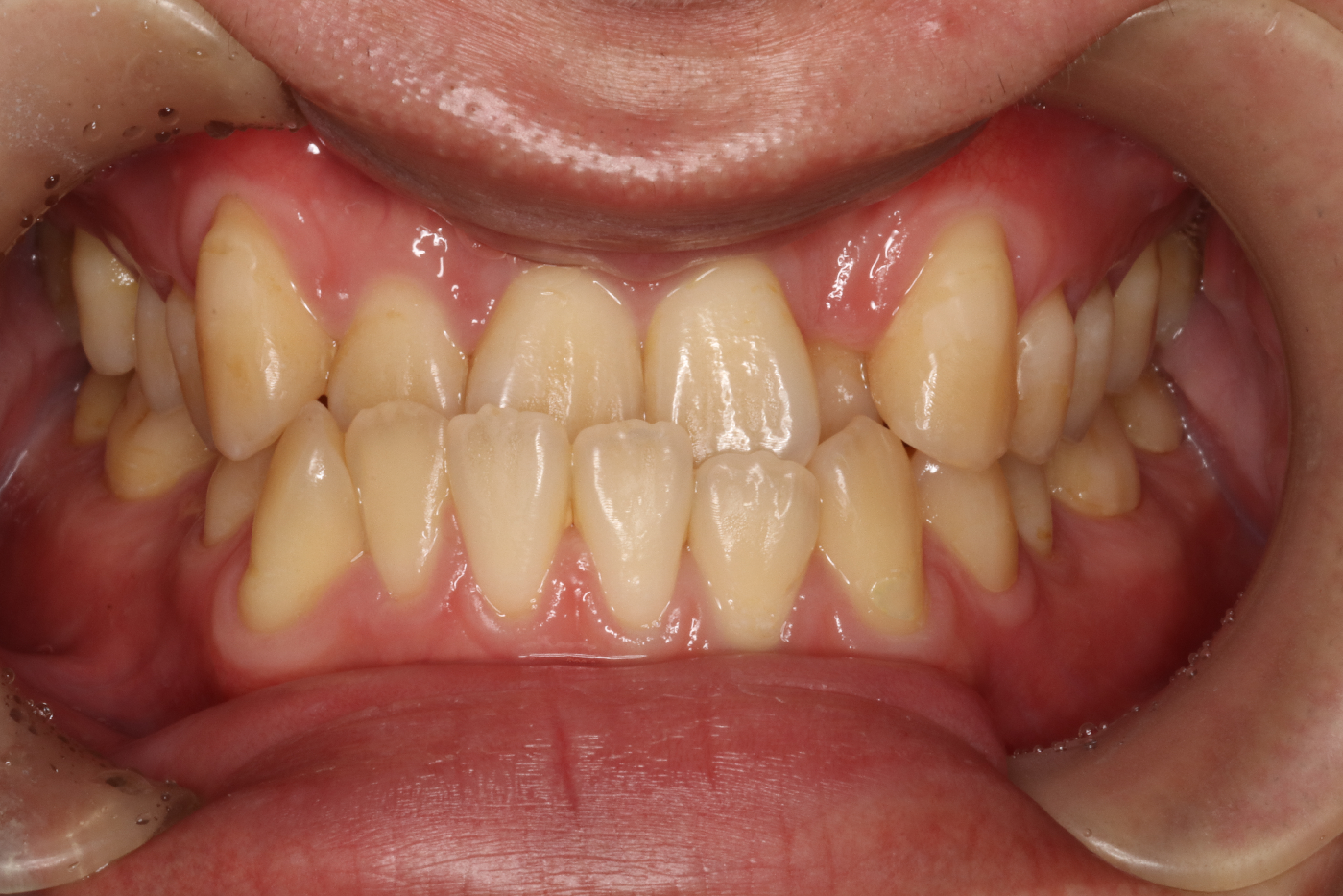 下顎前突・ハーフリンガル