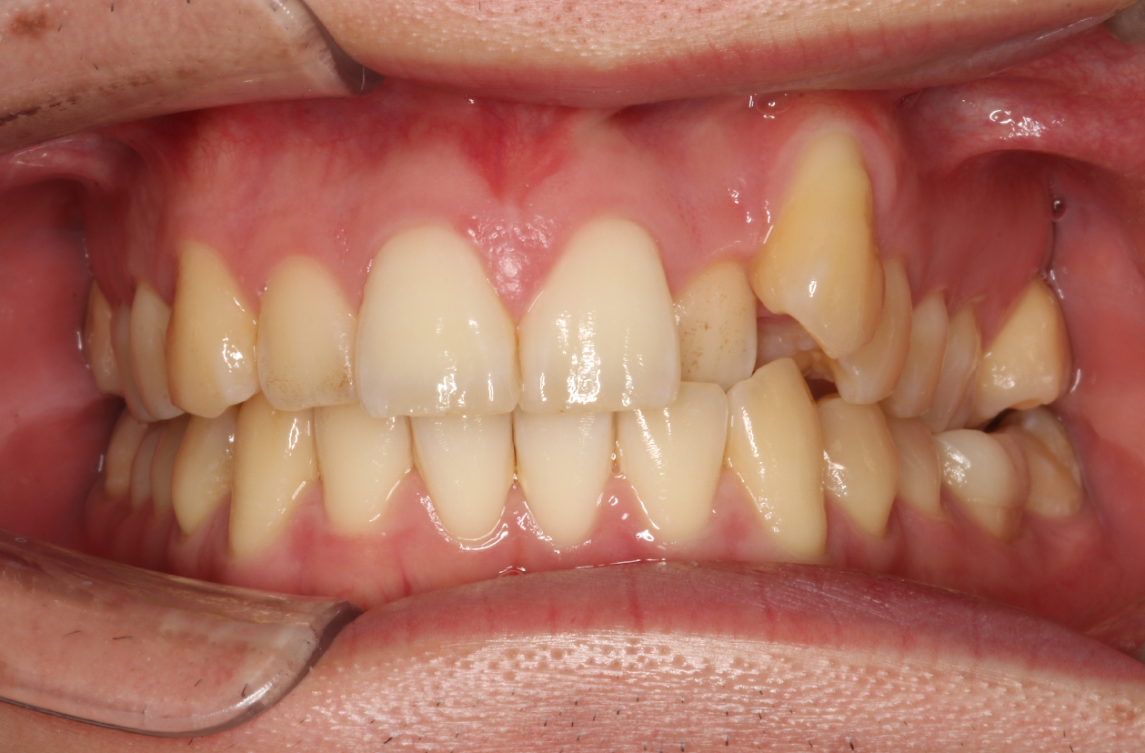 八重歯、叢生・ハーフリンガル矯正の症例