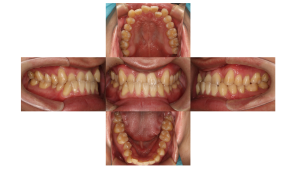 下顎前突・ハーフリンガル矯正の症例