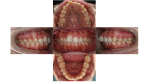 上顎前突・叢生・リンガルの症例
