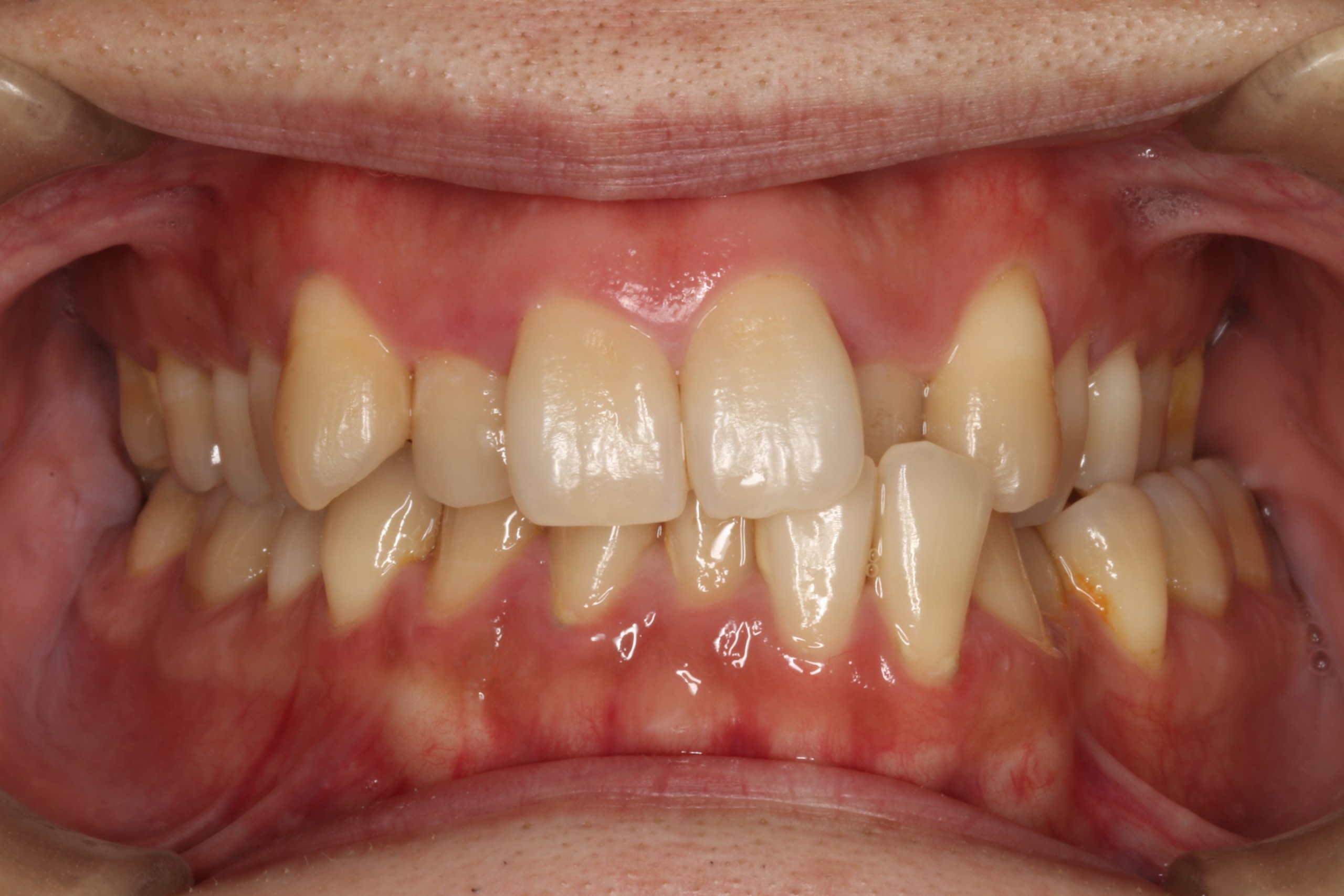 叢生・リンガル矯正の症例