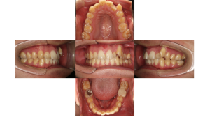 八重歯、叢生・ハーフリンガル矯正の症例
