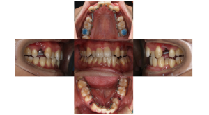 叢生・リンガル矯正の症例