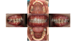 上顎前突・叢生・リンガルの症例