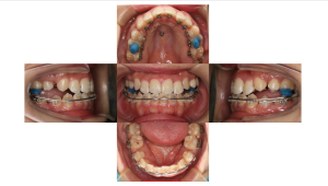 叢生・ハーフリンガル矯正の矯正