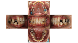 叢生・裏側矯正の症例