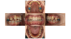 上顎前突・叢生・ハーフリンガルの症例
