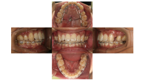 叢生・ハーフリンガル矯正の症例