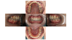 上顎前突・叢生・ハーフリンガルの症例