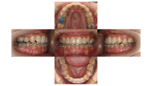 叢生・ハーフリンガル矯正の矯正