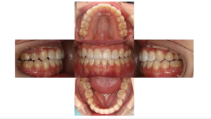 叢生・ハーフリンガル矯正の矯正