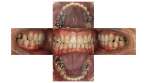 叢生・裏側矯正の症例