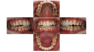 叢生・ハーフリンガル矯正の症例