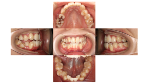 叢生・ハーフリンガル矯正の症例