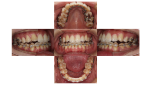 叢生・ハーフリンガル矯正の症例