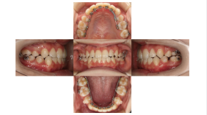 リンガル・叢生