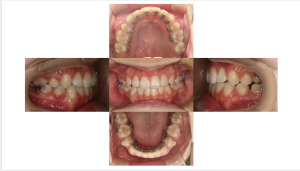 リンガル・叢生