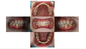 リンガル・叢生