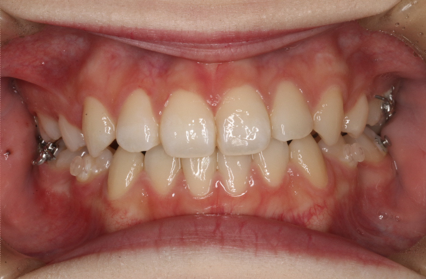 リンガル・叢生