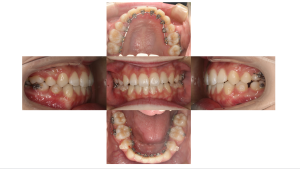 リンガル・叢生