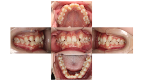 リンガル・叢生