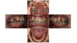上顎前突・叢生・ハーフリンガルの症例