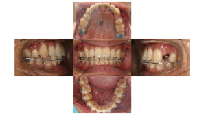 叢生・ハーフリンガル矯正の症例