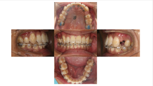 叢生・ハーフリンガル矯正の症例