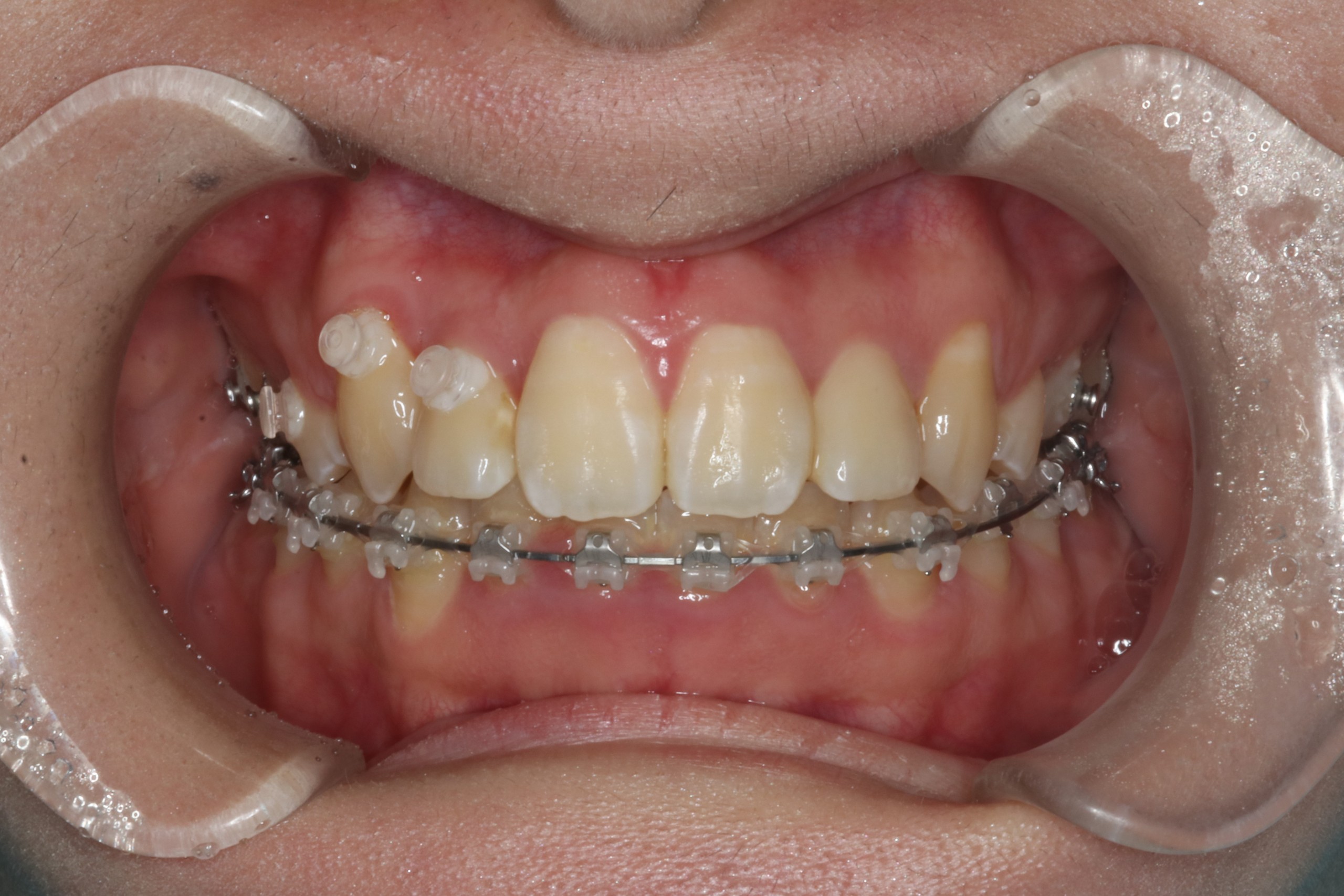 八重歯・叢生・ハーフリンガルの症例