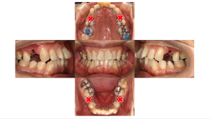 叢生・裏側矯正の症例