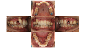 叢生・ハーフリンガル矯正の症例